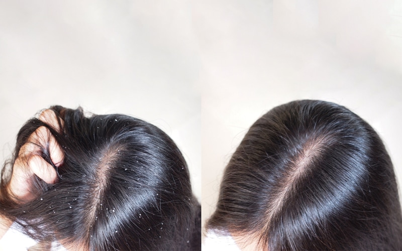 Dandruff-2.jpg