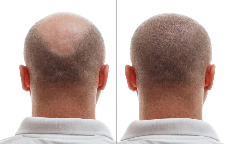 trico-pigmentation1.jpg